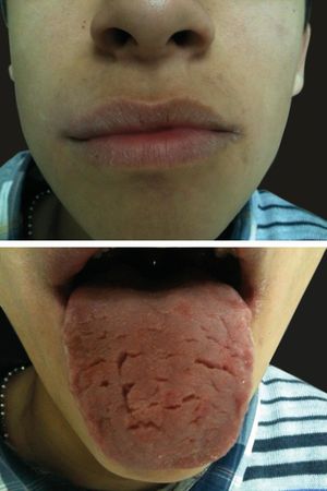 Patient 2 at 5-month follow-up. A: Mild lip swelling, with dry lips. B: Fissured tongue persisted; geographic tongue has a milder expression