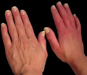 Erythema and edema on both hands, more pronounced on the right