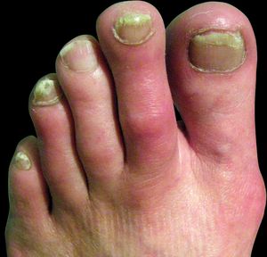 Combined erythema and edema due to foot erythromelalgia