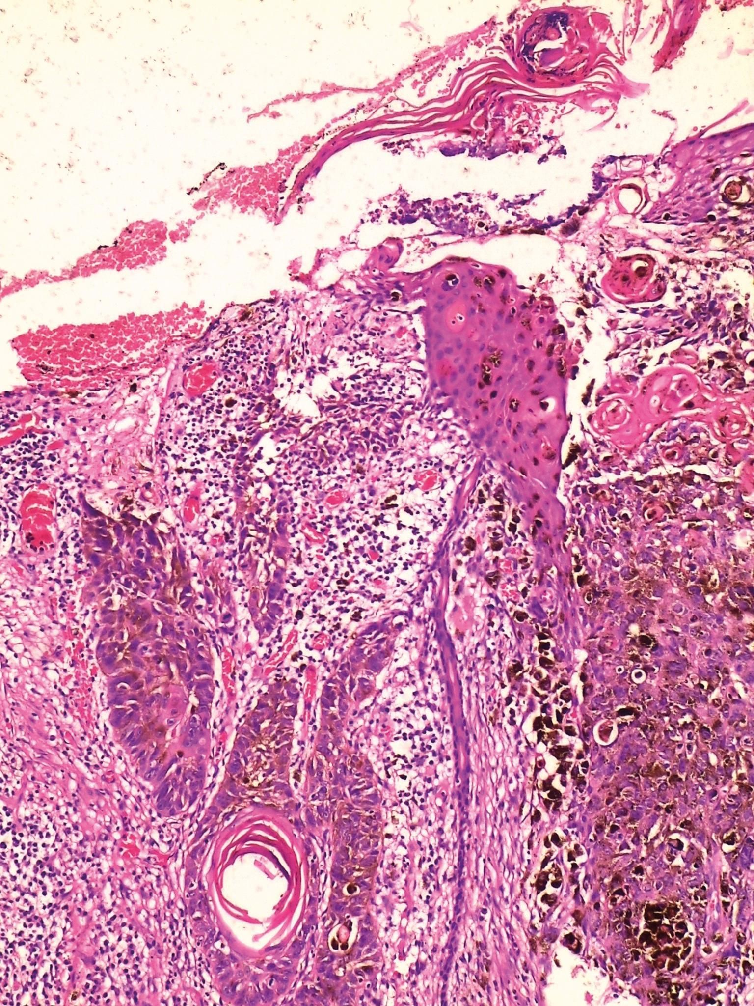 Pigmented squamous cell carcinoma: case report and importance of ...