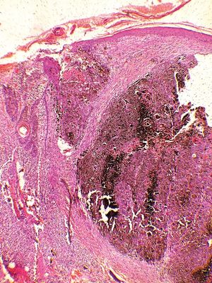 Lobular dermal neoplasm of epidermal origin with abundant melanin pigment (Hematoxylin & eosin, X40)