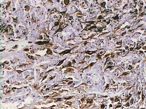 Immunohistochemistry: expression of melan-A (Mart1) in melanocytes