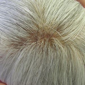 Well-delimited hair rarefaction area on the scalp, “broom fibers” displaying a tonsure pattern, politrychia, and moderate perifollicular scaling