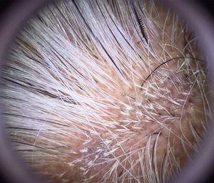 Dermoscopy: erythema, perifollicular desquamation, and tonsure pattern