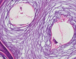 Hamburger sign: hyperkeratosis with hairs split into two segments by a layer of red blood cells (Hematoxylin & eosin, X40)