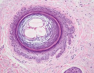 Gear wheel sign: outer root sheath forms acanthotic jagged projections (Hematoxylin & eosin, X40)