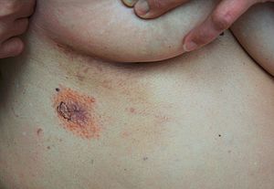 A. Multiple orange papules and nodules on her right abdomen.