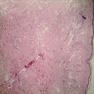 B. Close view of right abdomen lesions showing scattered orange, atrophic, different sizes appearance of lesions