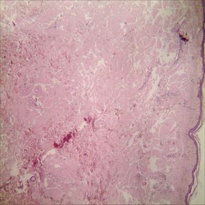 A. Biopsy of the lesion showing atrophy of the epidermis, collections of reddish amyloid protein deposited in the dermis, subcutaneous tissue, and around the blood vessels (Hematoxylin & eosin,X40).