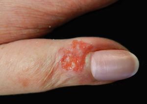 Granulomatous and friable ulcer with infiltrated margins, measuring approximately 2cm, located in the periungual region of the left thumb
