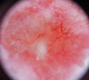 Dermoscopy showing an erythematous lesion with typical thin and branched arboriform vessels and a white halo and ulceration