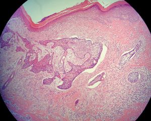 Peripheral palisade of basaloid cells and adjacent retraction, as well as swirls of squamous cells (Hematoxylin & eosin, X40)