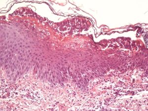 Subcorneal spongiform pustule (Hematoxylin & eosin, X200)