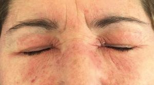 Heliotrope rash