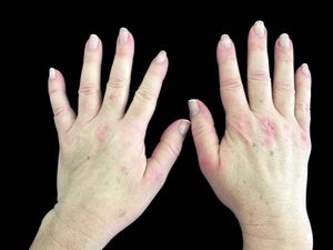 Gottron’s papules observed on the hands
