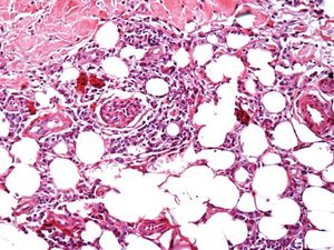 Inflammatory lymphocytic infiltrate in the hypodermis, permeating adipose cells without septal thickening (Hematoxylin & eosin, X400)