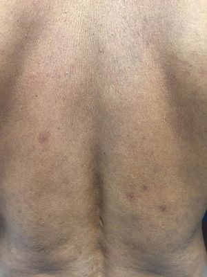 Irregular and poorly delimited brownish macules and spots on the back