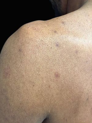 Brown colored erythematous nodules of 0.5-1.0 cm in size located on the proximal part of the upper limbs