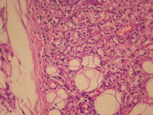 Diffuse interstitial chronic dermatitis, with lymphohistiocytic infiltrate (Hematoxylin & eosin, X10)