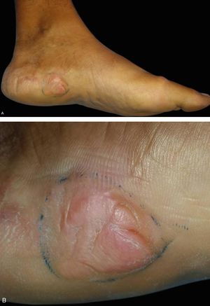 A: Slightly erythematous 4-cm plaque in its largest diameter with hyperkeratotic and grooved surface in the medial plantar region of the left lower limb. B: Detail of the lesion