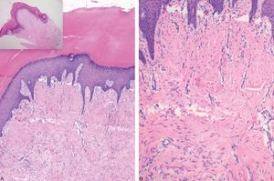 A: Compact hyperkeratosis, irregular acanthosis and papillomatosis (Hematoxylin & eosin, X100). B: Proliferation of fibroblasts and thick collagen fibers forming vertically oriented bundles in the papillary dermis and in part of the reticular dermis. Note the presence of vertically oriented proliferated blood vessels (Hematoxylin & eosin, X200)