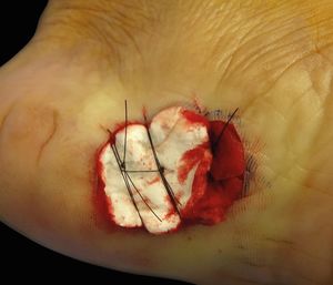 Immediate post-operative period, dressing with sterile absorbable gelatin sponge. Suture performed only to fix the sponge during the first two days