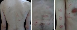 Corymbiform secondary syphilis with lesions disseminated throughout the body formed by a central papule surrounded by smaller ones