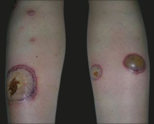 Multiple tense, fluid-filled blisters of variably sized, with surrounding erythema, located on the lower limbs