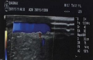 Doppler did not show thrombosis of the dorsal vein of the penis or corpora cavernosa