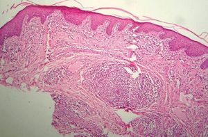 Histologic findings fo the lesion. Hyperkeratosis and irregular acanthosis in the epidermis, along with swollen superficial and deep vessels surrounded by a dense inflammatory reaction of lymphocytes, plasma cells and epithelioid cells. (Hematoxylin & eosin, X10)