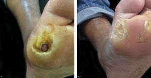 Left plantar ulcer before A: and after B: 10-month treatment