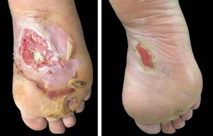 Right plantar ulcer before A: and after B: 4-month treatment