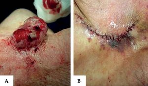 A - 6 cm-diameter tumor. B - Immediate postoperative period