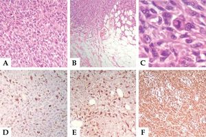 A: Intense proliferation of pleomorphic cells in the dermis (Hematoxylin & eosin, X200); B: Infiltration of adipose tissue with neovascularization (Hematoxylin & eosin, X100); C: Fusiform and polygonal pleomorphic multinucleated cells with hyperchromasia of the nucleoli and mitotic figures (Hematoxylin & eosin, X400); D: Immunohistochemistry 90% highly positive for Ki-67 antibody, a cell proliferation marker, CD-68; E: A macrophage marker (IHC, X200); and F: Vimentin, a mesenchymal cell marker, IHC X100).