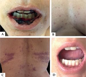 A: severe oral mucositis with hemorrhagic crusts B: papules with central necrosis in the pre-sternal region. C: involvement in areas of pressure. D: significant improvement after suspension of medication and replacement of folinic acid
