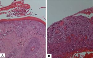 Light microscopy with necrosis of epidermis A: and oral mucosa B: Hematoxylin & eosin, X400