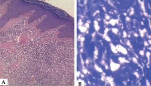 A: Hyperplastic epidermis with orthokeratosis, hypergranulosis, irregular acanthosis, and spongiosis on the dermis with moderate inflammatory infiltrate formed by lymphocytes, histiocytes, rare plasmocytes, and eosinophils (Hematoxylin & eosin, X4) B: Leishmania inside macrophages (Hematoxylin & eosin, X40)