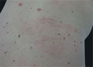 Clinical improvement after 4 months of topical corticotherapy