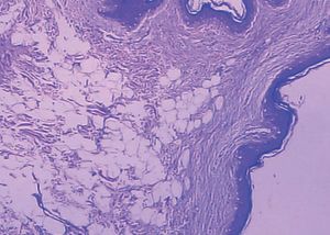 Mature fat tissue in the dermis, more prominent around the vessels and associated to the presence of perivascular and interstitial dermal mast cells (Hematoxylin & eosin, X40)