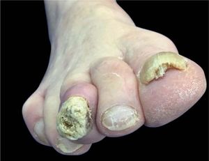 Clinical examination. Third toe with important onychodystrophy and an erythematous nodule on the proximal nail border