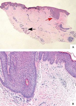 A - Hematoxylin & eosin, X10. Hyperkeratosis and irregular acanthosis, some mononuclear cells (indicated by red arrow) forming an infiltrate around hair follicle; dilation of sweat gland ducts (indicated by black arrow) in the lower-mid dermis. B - Hematoxylin-eosin, X100. Follicular spongiosis, some lymphocytes and a few histocytes and eosinophils