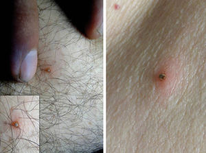 Adult ticks of the Amblyomma genus attached to human skin. The mouthparts of these arthropods are serrated and hard to extract. The permanence of fragments causes foreign body-type granulomas. Photos: Vidal Haddad Jr.