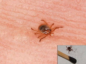 Ticks of the Ixodidae family (Amblyomma sp.) on human skin. Photos: Vidal Haddad Jr.