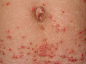 Massive infestation of hexapod larvae, with firm papules. In this phase, the arthropods are small and difficult to visualize. Photo: Eliete Correa Soares