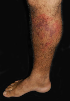 Bull’s eye sign in erythema migrans is indication of the initial manifestation of Lyme borreliosis and is caused by the dissemination of the spirochete in a concentric fashion. Photo: Mônica Soares