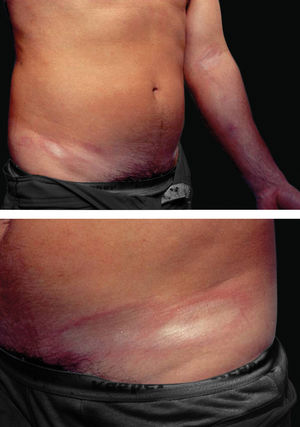 Infections caused by Borrelia sp. Can be associated to chronic sclerodermiform states. Among those, it is possible to see plaque scleroderma (such as in this patient with positive serology for Borrelia and spirochetes on histopathology). Photo: João Luiz Costa Cardoso