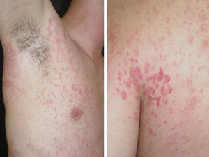 The early papular rash on the wrists and ankles can spread and become purpuric (petechiae), a sign of increasing severity in rocky mountain spotted fever. Photos: Department of Dermatology FMB UNESP