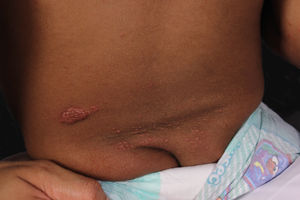 Sparse and grouped vesicles on the back