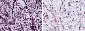 To the left, positive vimentin (X200); to the right, focally positive smooth muscle actin (X200)