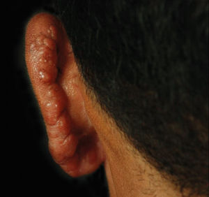 Keloid-like lesions and diffuse infiltration on the earlobe and posterior helix